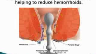 Hemorrhoids Treatment  Peristal Hemorrhoid Massager Treatment [upl. by Haymo]