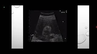 Ultrasound case1 Adenomyomatosis with cholesterol crystals in the gallbladder wall [upl. by Spain]