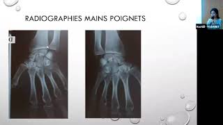 « Cas cliniques polyarthrite rhumatoïde » Dr SAbdellaoui [upl. by Leahci74]