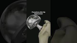 Posterolateral Hip Replacement Precautions [upl. by Akeenahs]