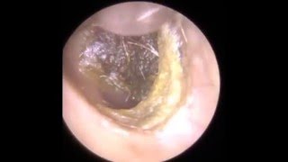 Endoscopic Ear Wax Removal Leicester  The Hear Clinic [upl. by Tnerual]