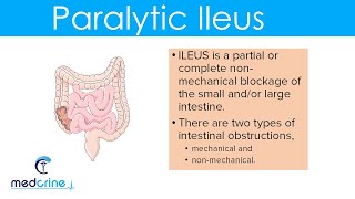 Paralytic Ileus  causes pathophysiology clinical features diagnosis and treatment [upl. by Baudoin]