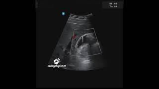 Gallbladder Adenomyomatosis [upl. by Niklaus]