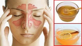 How To Get Rid of a Sinus Headache Fast  Sinus Pressure Relief [upl. by Dewhirst358]