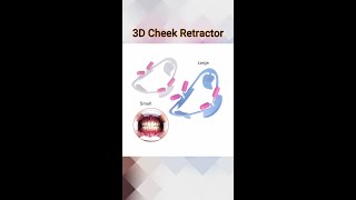 3D Cheek Retractor and Mouth Opener [upl. by Sayles254]