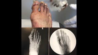 Keyhole Bunion Surgery  The naked truth about minimal invasive bunion surgery my full recovery [upl. by Lubet435]