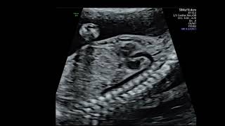 Fetal Echocardiography  sagittal arches view [upl. by Ahsiket]