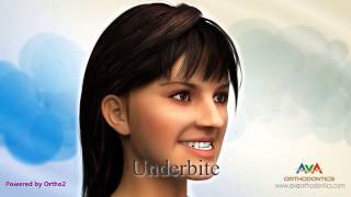 Malocclusion  Different Types [upl. by Gabrielson428]