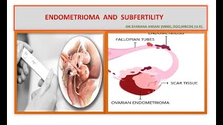 ENDOMETRIOMA AND FERTILITY OPTIONS FOR MRCOG PART3 [upl. by Ymmac]