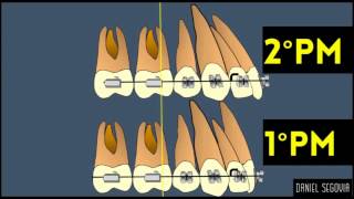 Extracción de segundos premolares en ortodoncia [upl. by Dehsar]