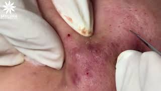 BLACKHEADS AND ACNE REMOVAL 1  Nặn mụn ẩn dưới da mụn đầu đen  黑頭和粉刺去除  0934000075 [upl. by Vipul]