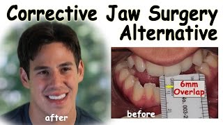 Corrective Jaw Surgery Alternative  Underbite Correction without Surgery [upl. by Gnat]