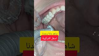 شاهد ماذا وجدنا اسفل تركيبة في عيادة طبيب الاسنان dentist اسنان stitch satisfying اكسبلور تسوس [upl. by Platt]