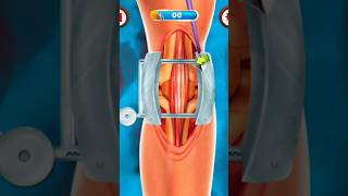 عملية تبديل مفصل الركبة Knee replacement surgery طب عملياتجراحية Surgery طبيب متعةوتعليم [upl. by Ydassac17]