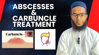 Abscesses amp Carbuncle Treatment  Fun Secrets  AsjadRaza FunSecrets [upl. by Crosse]