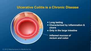 What is Ulcerative Colitis [upl. by Towney]