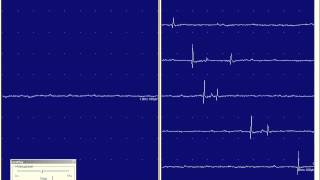 LEMG with insertion activity and interferring fibrillation potentials [upl. by Llednahc]