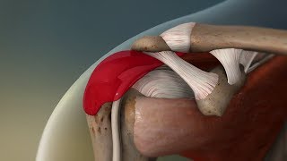 shoulder bursitis exercises the best treatment [upl. by Florinda736]