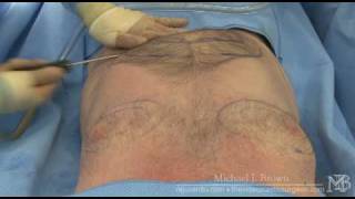 Ultrasonic liposuction of a mans chest and abdomen [upl. by Oiromed154]