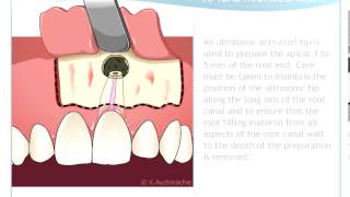 Endodontic Microsurgery [upl. by Frieder]