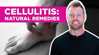 Are There Natural Remedies for Cellulitis [upl. by Helena]