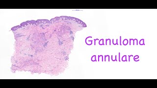 Granuloma annulare [upl. by Talbott41]