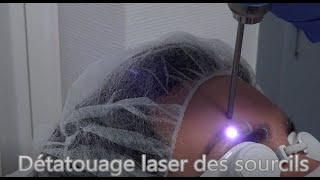 Détatouage laser des sourcils sans douleur technique simple et rapide avec une machine performante [upl. by Lejna]