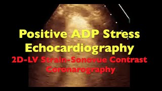 Positive ADP Stress Echo 2D LV Strain Sonovue Contrast Coronarography [upl. by Baruch]