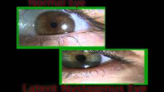 Comparison Latent Nystagmus VS Normal Eye [upl. by Copland]