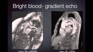 Cardiac MRI Pulse sequences [upl. by Nnylirret365]