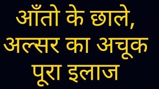 DUODENAL ULCER BEST TREATMENTआंतों के छालेघावड्यूओडनल अलसर का स्थाई इलाज एवं जानकारीआयुर्वेद [upl. by Llert]