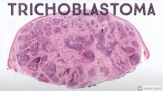 Trichoblastoma amp Trichoepithelioma Benign Hair Follicle Tumor Mimic of Basal Cell Carcinoma [upl. by Nathanson157]