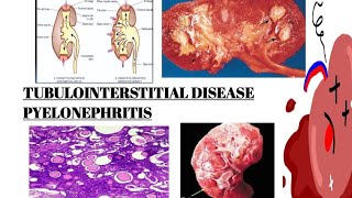 PYELONEPHRITIS  TUBULOINTERSTITIAL DISEASE PART 2  IMAGES  MCQs [upl. by Aubreir]