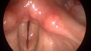 Videostroboscopy Raspy Voice amp Nodules medical and aesthetic treatments [upl. by Yelrihs]