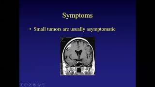 Which Meningiomas Should Not Be Treated [upl. by Soinski]