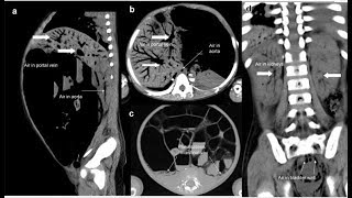 Pneumatosis intestinalis und tödliche portosystemische Luftembolie [upl. by Whall357]