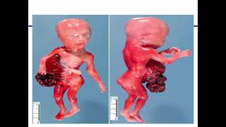 Abnormalities of placenta and cord OBG Nursing [upl. by Eendyc60]