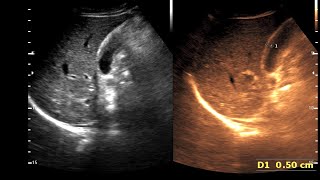 Adenomyomatosis Gall Bladder  RokitanskyAschoff sinuses [upl. by Ronni200]