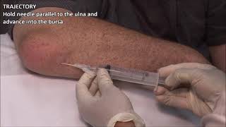 Olecranon Bursitis  Aspiration and Injection  In Vivo Series [upl. by Lokin]