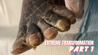 EXTREME FOOT TRANSFORMATION  PART 1 [upl. by Marshal]