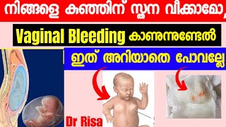 Vaginal Bleeding amp Breast Swelling in New Borns Baby Care Tips Malayalam [upl. by Rahmann]