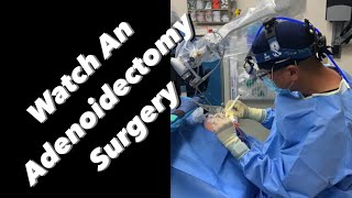 Adenoidectomy  actual footage [upl. by Atiras]