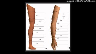 Evaluation of lymphedema in upper extremities by MR lymphangiography Comparison with lymphoscintigr [upl. by Zobkiw]