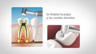 Endodoncia ¿cómo se realiza [upl. by Ludlew]