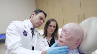 Face transplant recipient speaks one year after surgery [upl. by Notniuq]