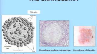 What is Sarcoidosis  Adam Morgenthau MD Mt Sinai Medical Center [upl. by Anawik462]