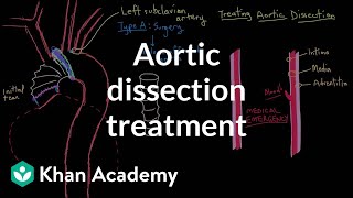 Aortic dissection treatment  Circulatory System and Disease  NCLEXRN  Khan Academy [upl. by Ybbor]