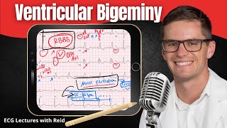 Ventricular Bigeminy EKG  ECG Lecture [upl. by Akinahc]