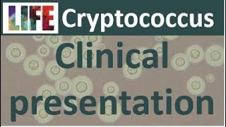 Cryptococcosis clinical presentation [upl. by Merc]