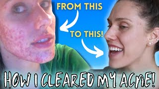 HOW I CLEARED MY ACNE  Chronic Cystic Digestive Hormonal [upl. by Aicilla]